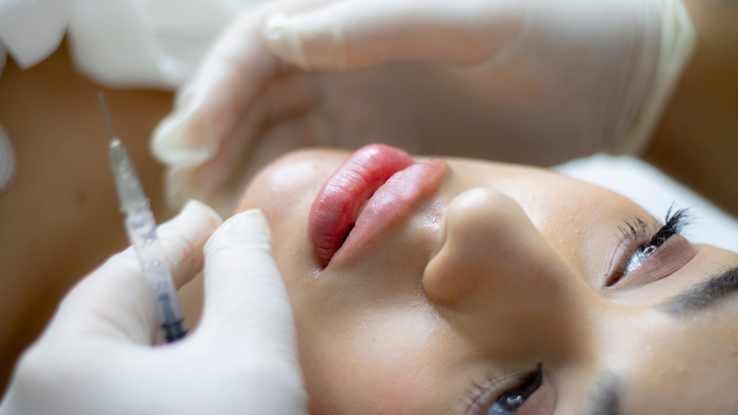NAR Med Bar lip filler treatment